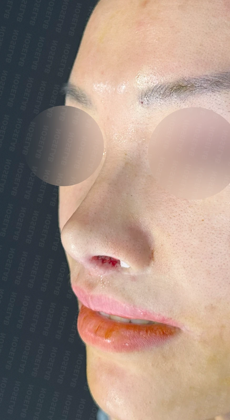 원하는 코 모양과 현재 구조를 함께 살펴보는 수술 계획 — 수술 전 / 수술 직후 0일 직후 사진은 부기가 있는 상태로 최종 결과와 다를 수 있습니다.