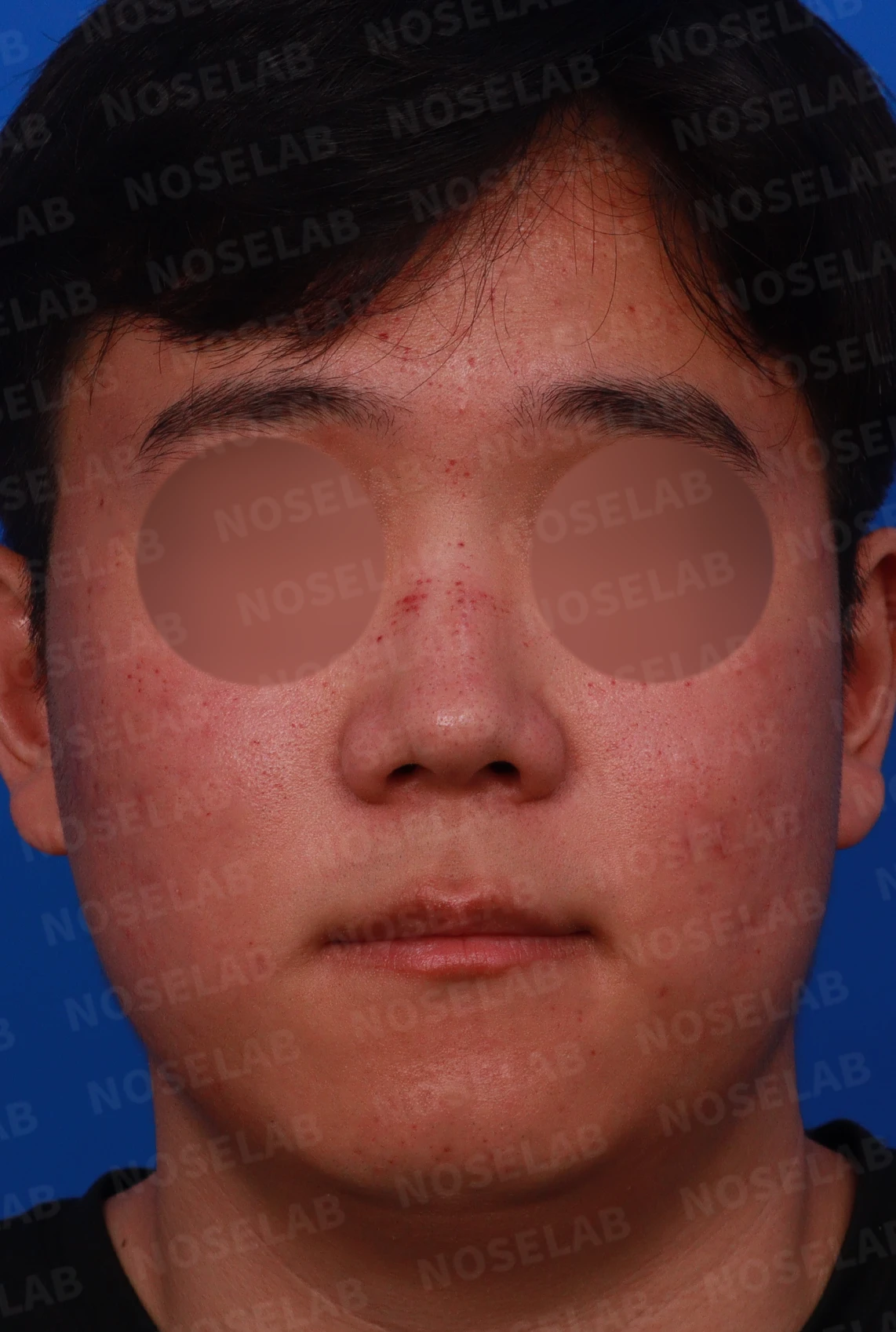 복코와 들린 코, 얼굴 비율을 고려한 교정 방법 — 디자인 상담 정면, 좌측 측면, 비스듬한 측면 사진