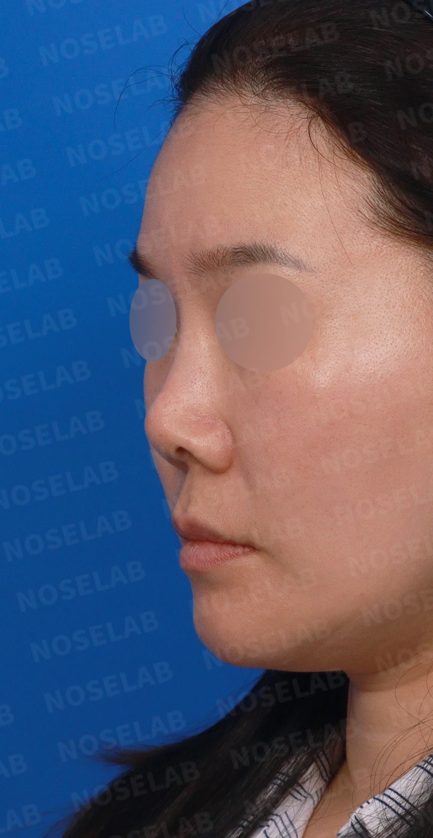 오래된 코성형 뒤 코끝이 들리고 콧구멍이 드러나는 이유, 제거와 자가진피 재건은 어떻게 하나 — 디자인 상담 정면, 좌측 측면, 비스듬한 측면 사진