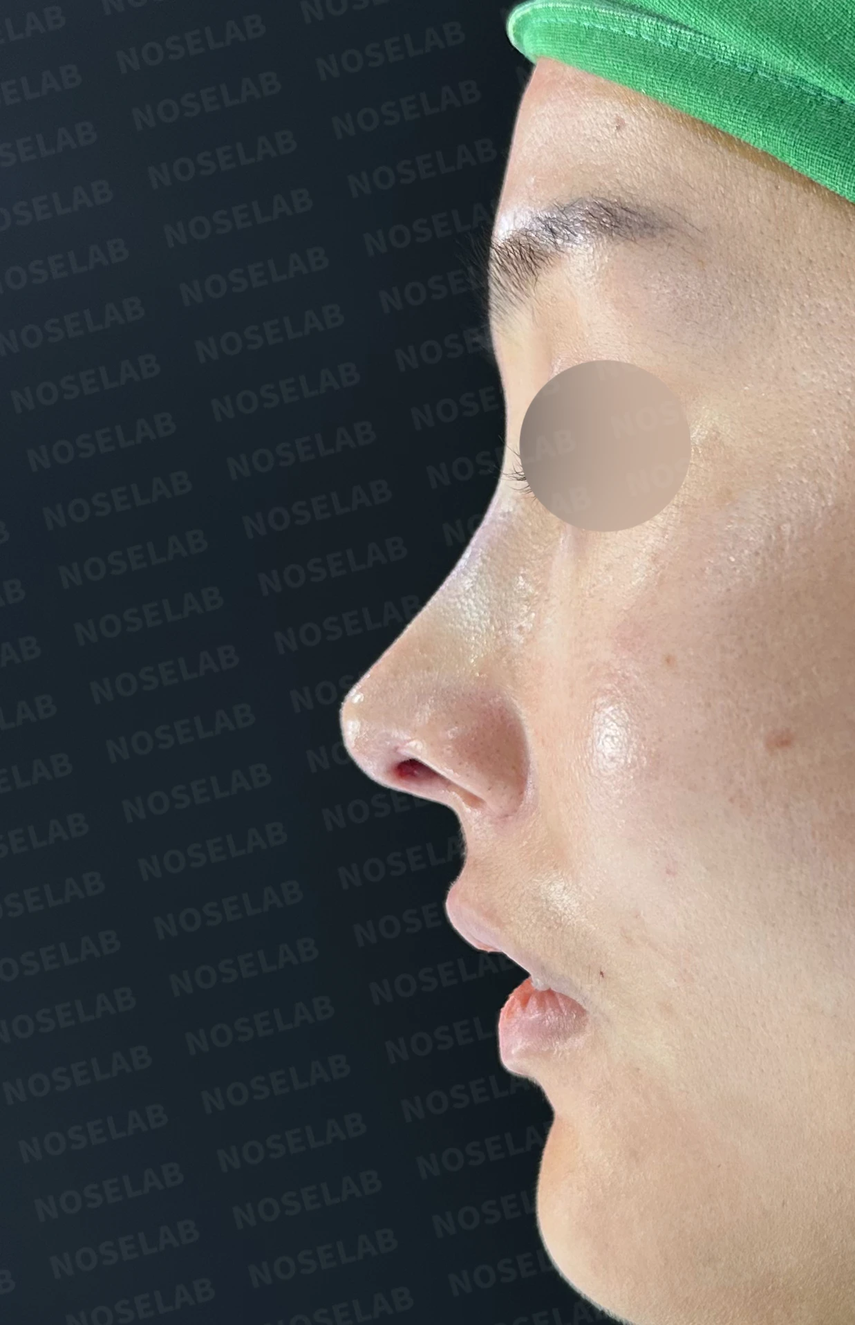 코성형 뒤 코끝이 처져 코가 길어 보이는 이유, 자가늑연골 코끝 재건 방법 — 수술 직후 0일 정면, 비스듬한 측면, 측면 사진입니다. 직후 사진은 부기가 있는 상태로 최종 결과와 다를 수 있습니다.