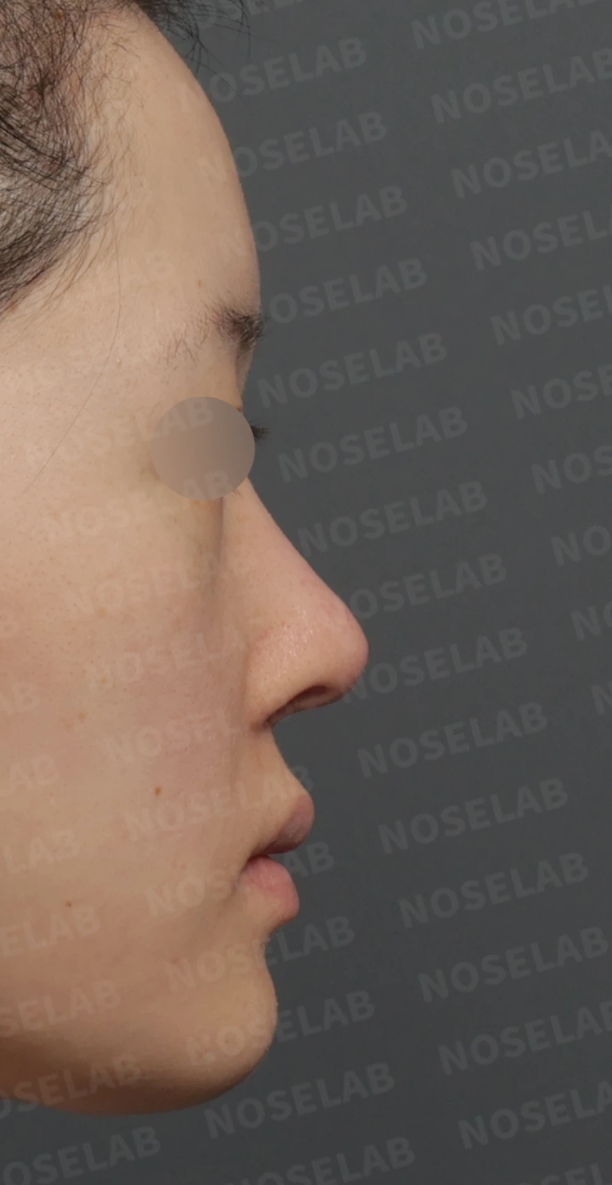 보형물 비침과 들린 코, 자가늑연골로 안전하게 교정한 코재수술 — 디자인 상담 우측 측면 , 비스듬한 측면 , 비공 사진입니다.