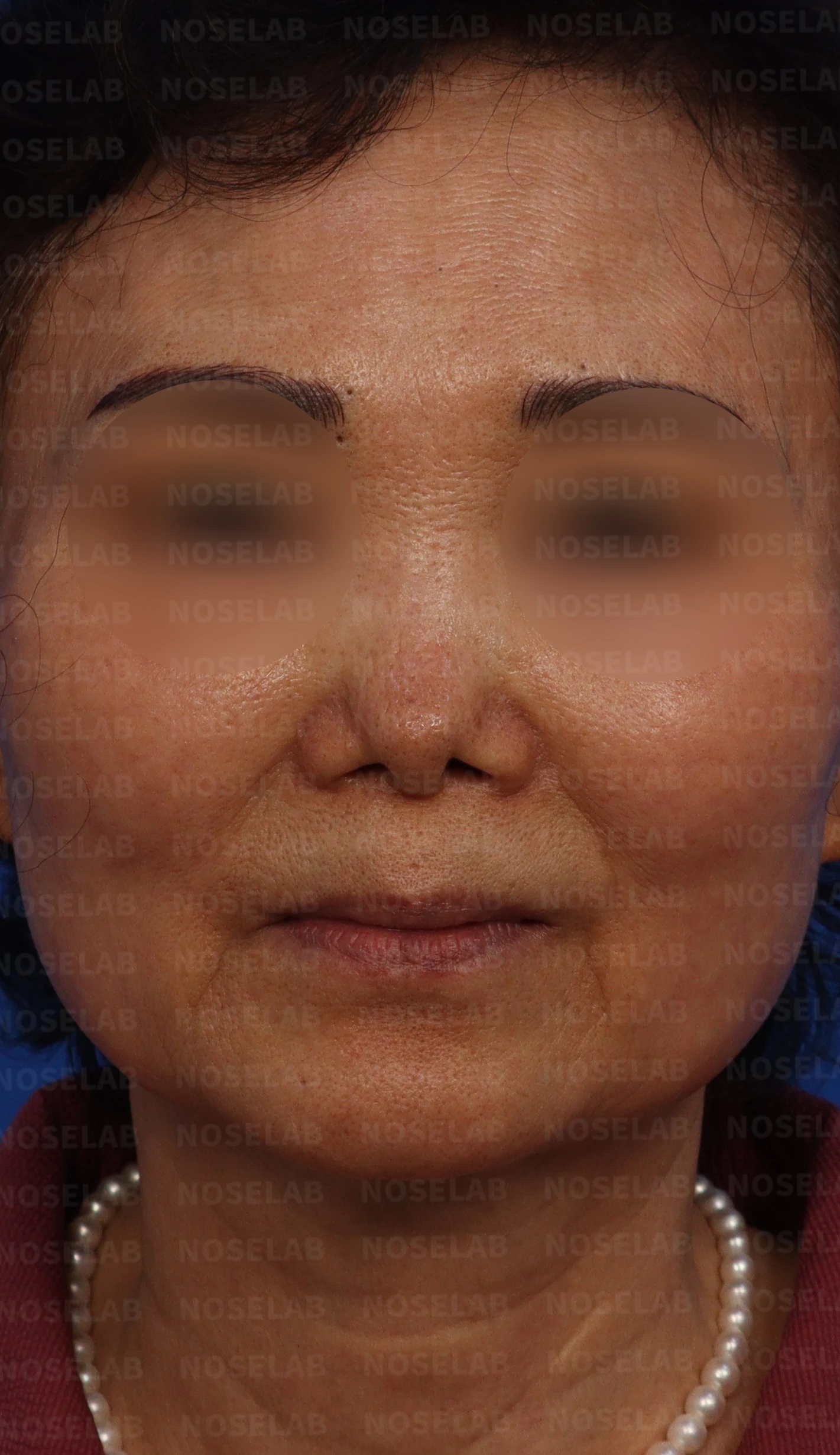비중격 천공이 있는 코의 재수술 계획 — 디자인 상담 정면, 우측 측면, 우측 비스듬한 측면 사진