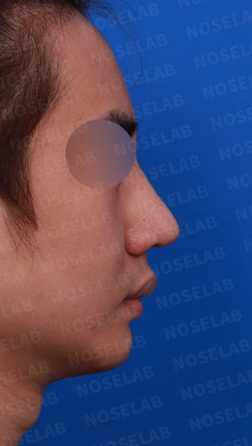 코뼈 골절에 미용 수술을 함께 할 수 있는 경우와 단계로 나누는 방법 — 디자인 상담 우측 비스듬한 측면, 측면, 비공 사진
