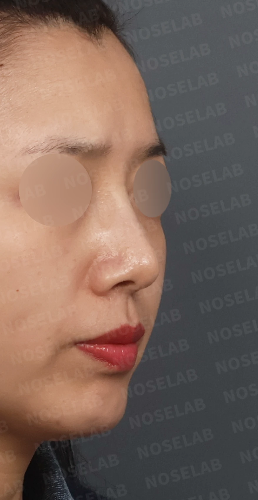 비공 비대칭과 휘어진 코, 자가늑연골 재건으로 교정한 코재수술 — 디자인 상담 우측 측면, 비스듬한 측면, 비공 사진