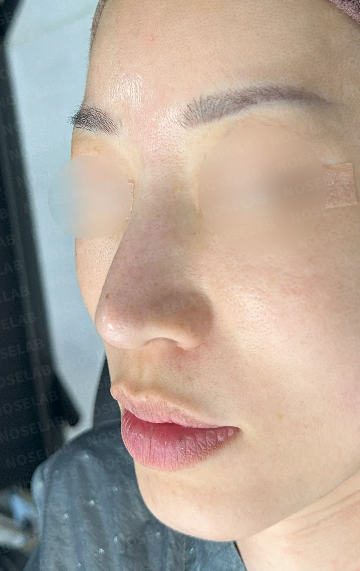 충격을 받은 뒤 코끝에서 소리가 나고 모양이 달라지는 이유와 늑연골 재건 — 수술 전 / 수술 직후 0일 직후 사진은 부기가 있는 상태로 최종 결과와 다를 수 있습니다.