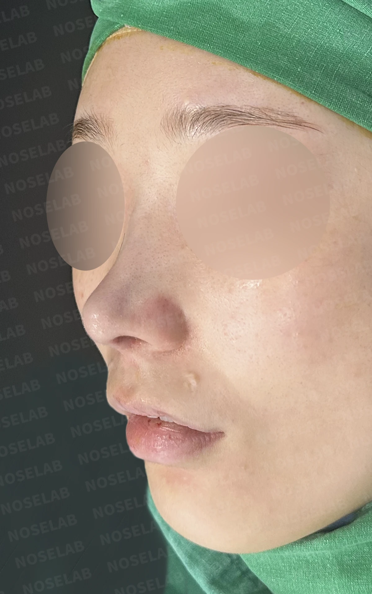 연골 노출 복원과 날개 연골 재건으로 안전하고 자연스러운 코 — 전(좌) , 직후(후)