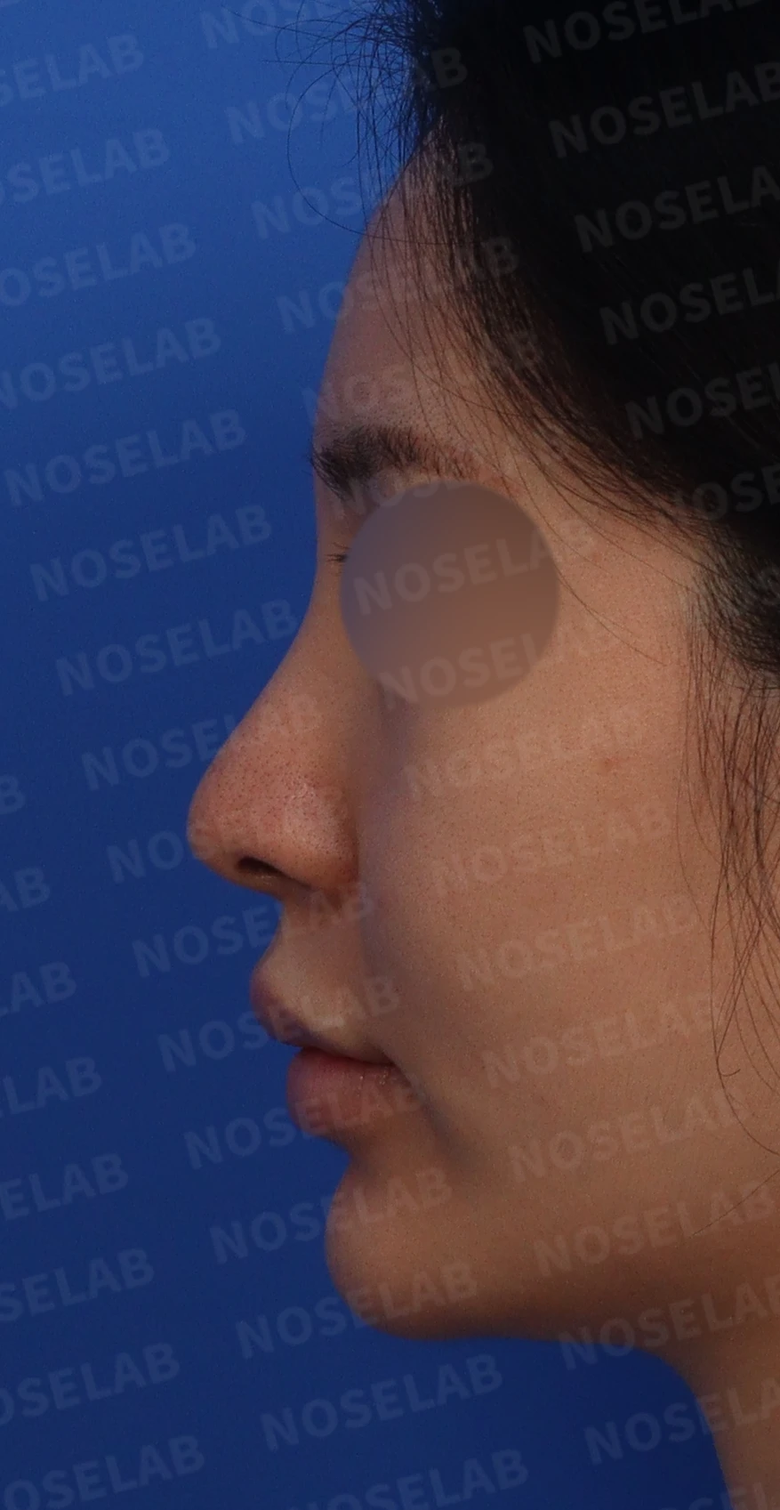 여러 코 모양 고민을 함께 살펴보는 코성형 계획 — 수술전 디자인 정면, 좌측 비스듬한 측면, 측면 사진입니다.