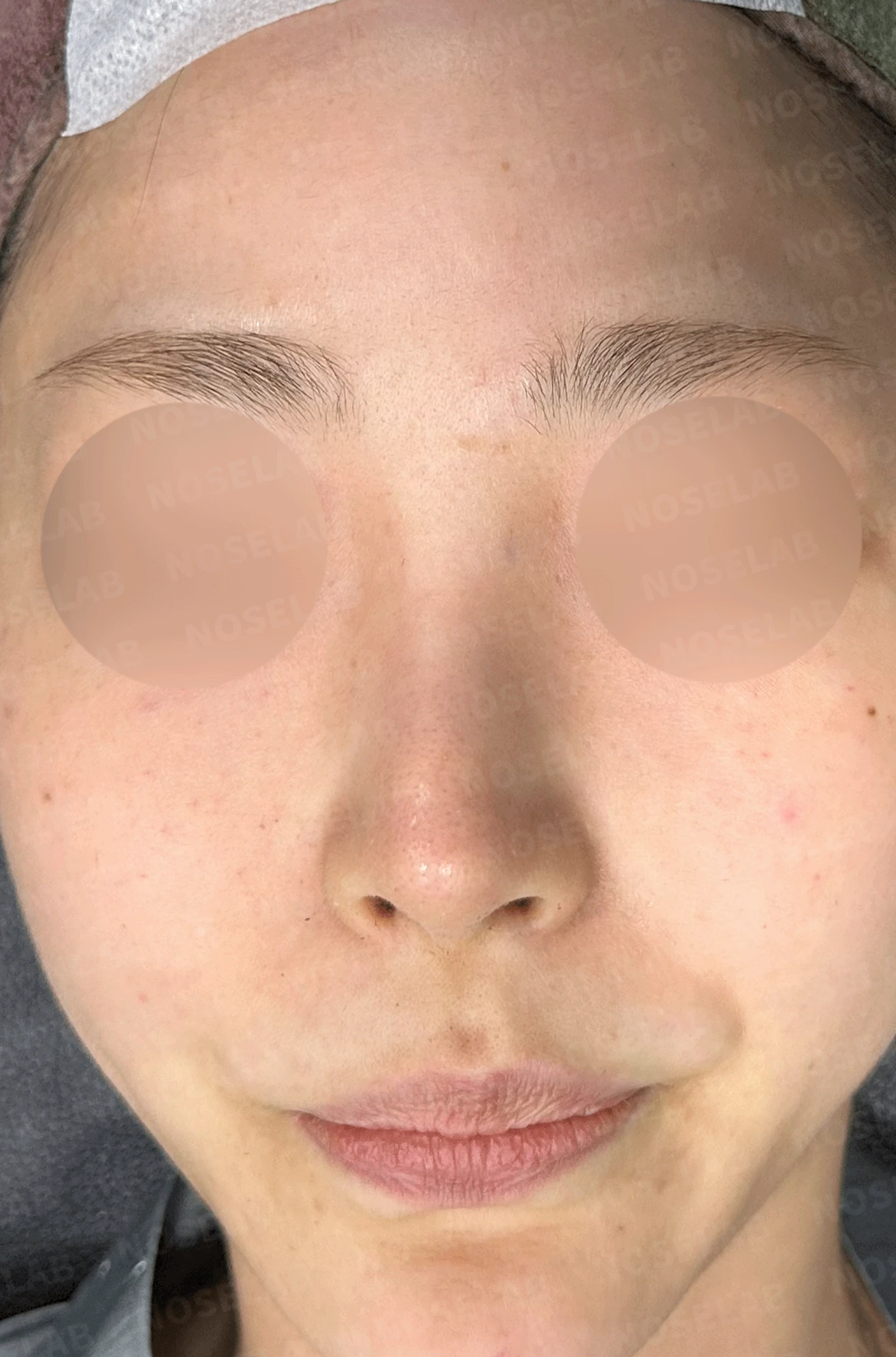 코끝 처짐과 코막힘을 함께 살펴보는 재수술 방법 — 본문 사진 10