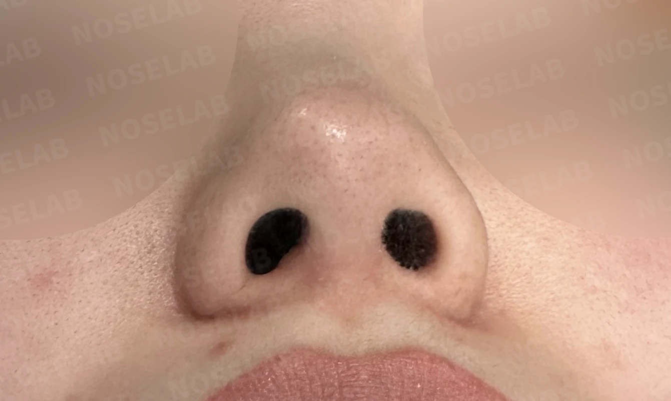 복코와 들린 코끝, 자가늑연골로 여성스러운 직반라인 완성 — 전(좌) 직후(후)