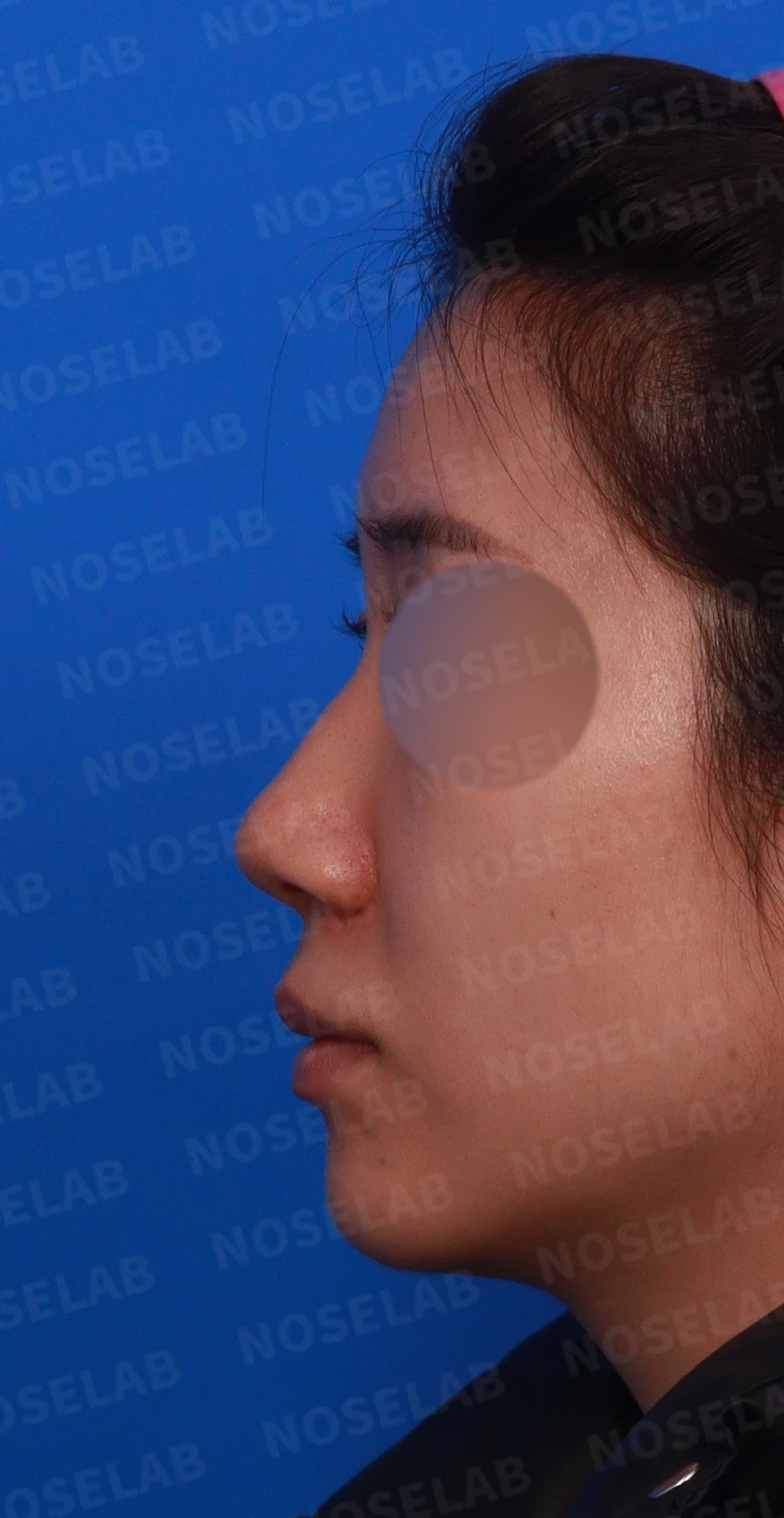코 필러를 녹이지 않은 채 코가 퍼져 보이는 이유, 얄쌍한 라인을 만드는 방법 — 디자인 상담 정면, 좌측 측면, 비스듬한 측면 사진