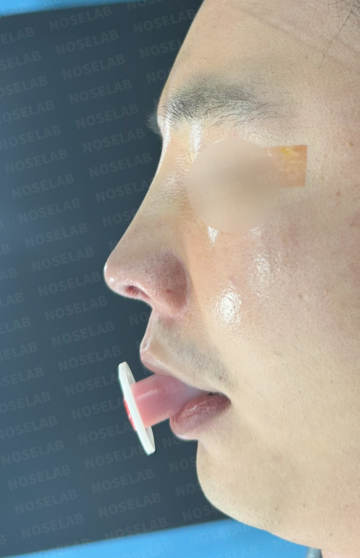 비중격 연골을 많이 쓴 코가 들리고 막히는 이유, 재건은 어떻게 하나 — 수술 전 / 수술 직후 0일 직후 사진은 부기가 있는 상태로 최종 결과와 다를 수 있습니다.