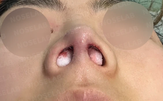 기능성 코성형·휘어진 비주 바로잡기 방법 — 수술 전 / 수술 직후 0일 직후 사진은 부기가 있는 상태로 최종 결과와 다를 수 있습니다.