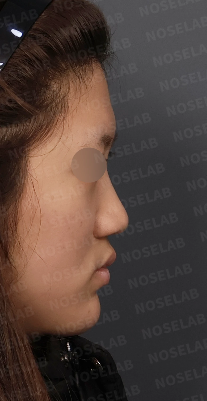 뭉툭한 코끝과 퍼진 코, 자가늑연골 비중격 연장술로 자연스럽게 교정 — 디자인 상담 우측 측면, 비스듬한 측면, 비공 사진입니다.