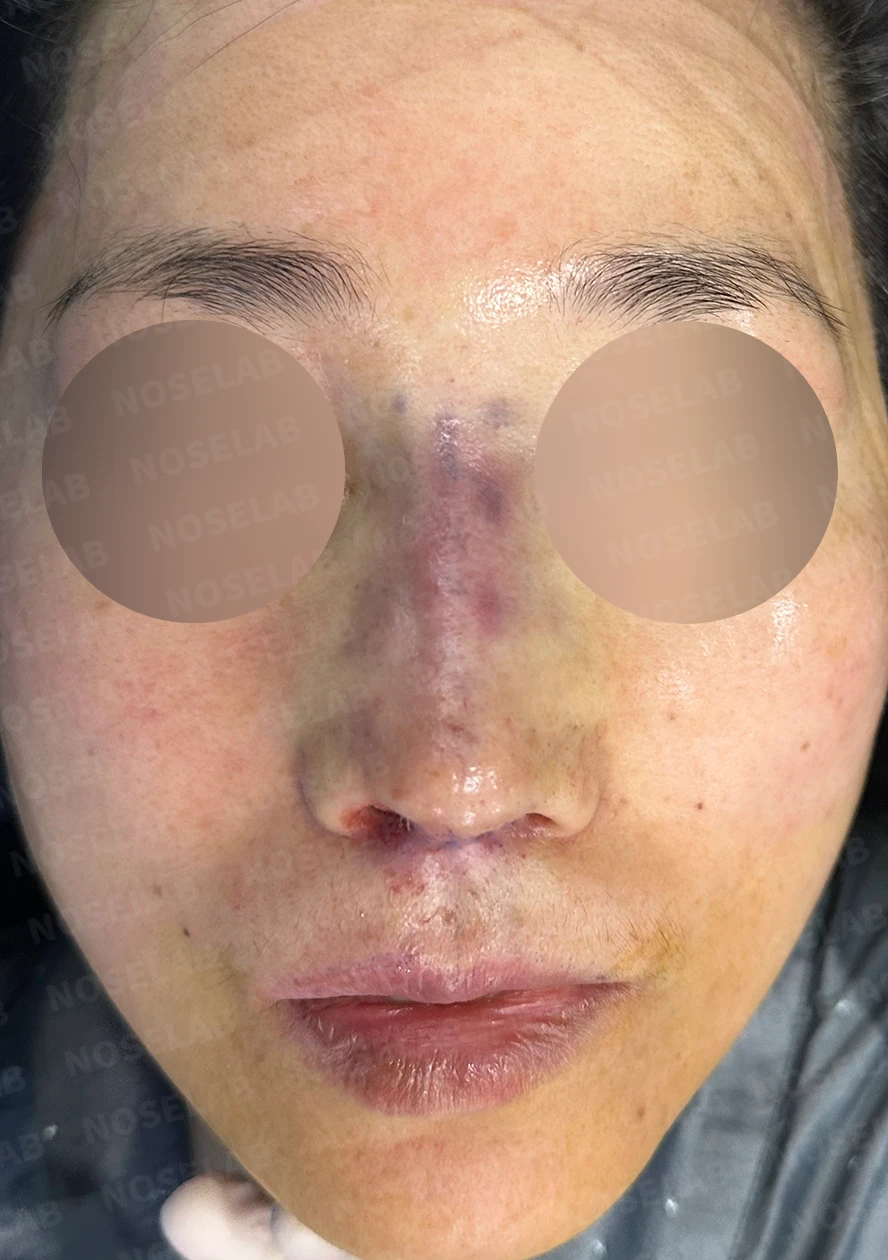 인중축소술 교정과 자가진피 제거 가능한가요? — 수술 전 / 수술 직후 0일 직후 사진은 부기가 있는 상태로 최종 결과와 다를 수 있습니다.