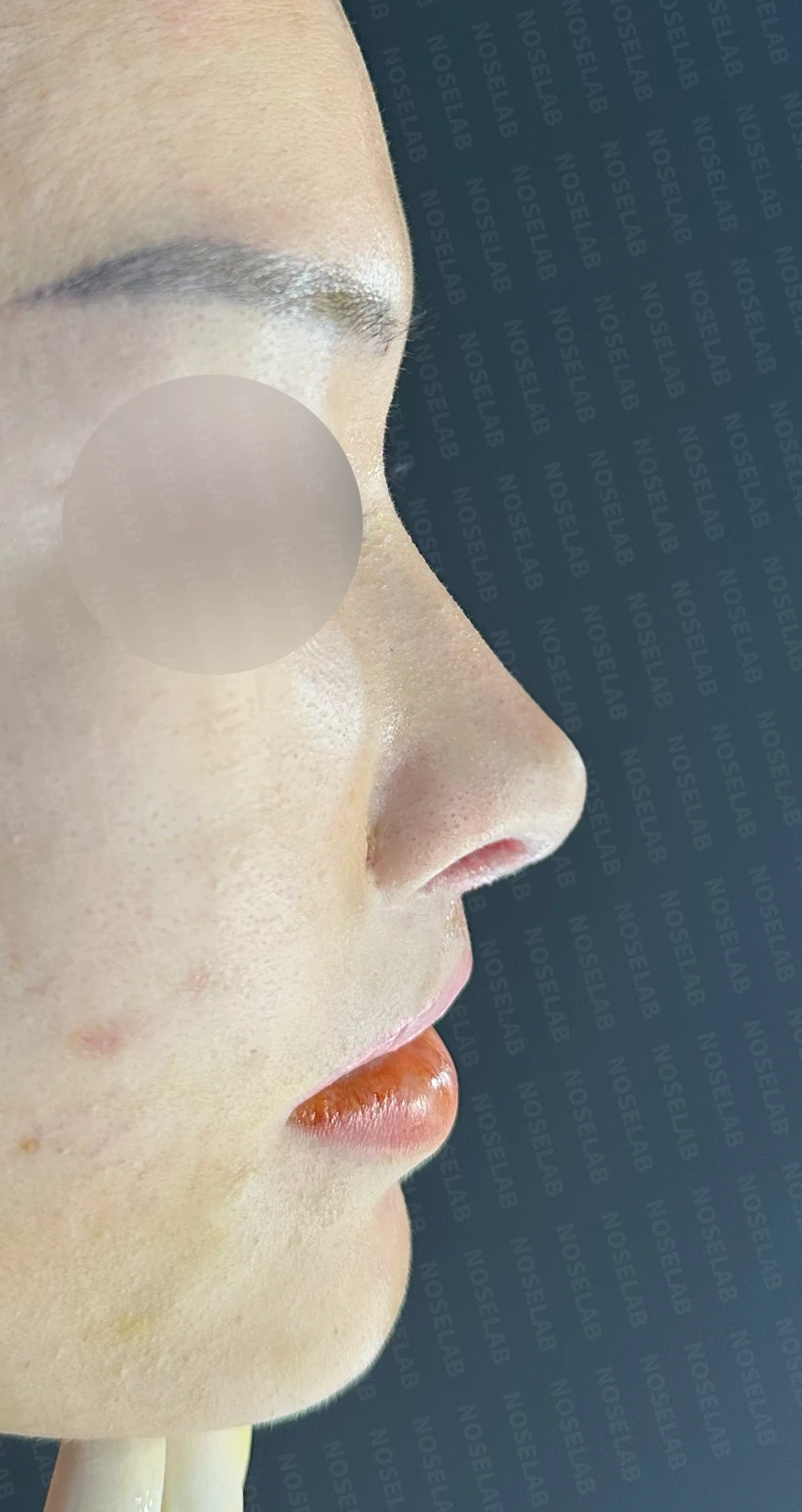 원하는 코 모양과 현재 구조를 함께 살펴보는 수술 계획 — 수술 직후 0일 정면, 측면, 비스듬한 측면 사진 직후 사진은 부기가 있는 상태로 최종 결과와 다를 수 있습니다.