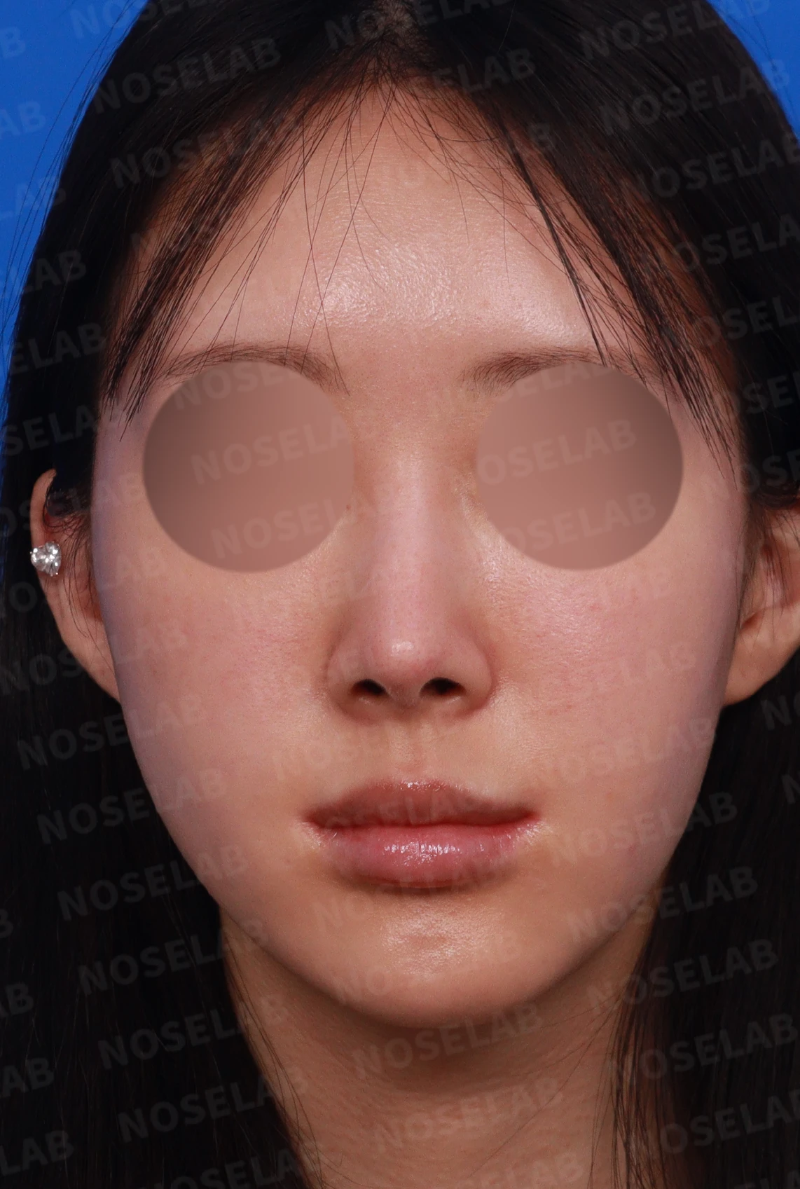뾰족한 코끝과 연골 비침 - 자가진피 코 재수술 후기 — 디자인 상담 정면, 좌측 측면, 비스듬한 측면 사진