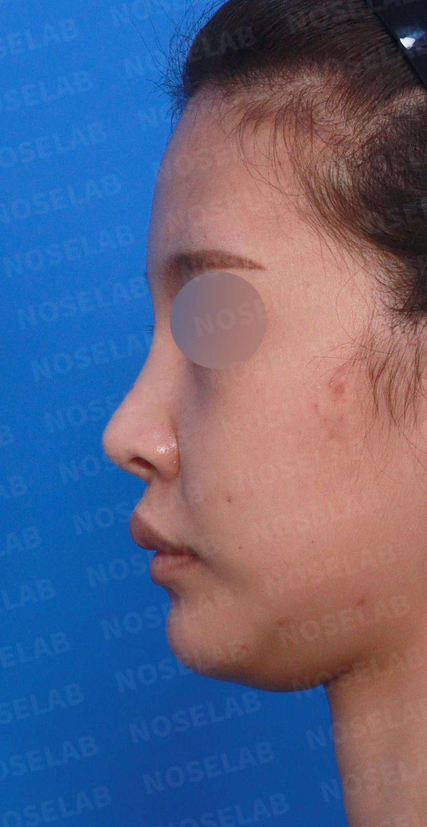 코 시작점이 높고 코끝이 들려 보이는 이유와 교정 방법 — 디자인 상담 정면, 좌측 측면, 비스듬한 측면 사진입니다.