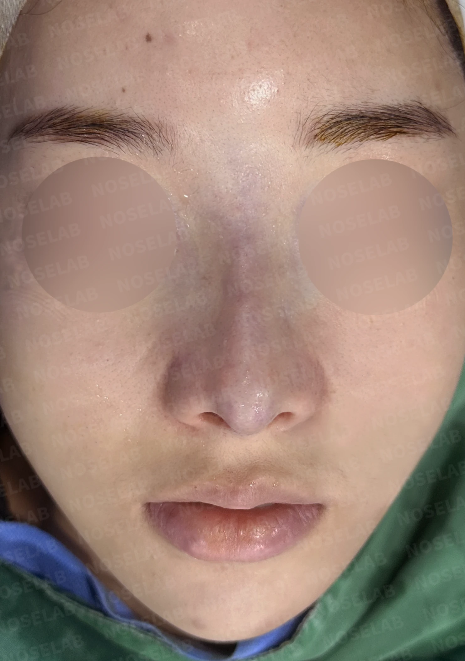 콧대가 넓고 단차져 보이는 이유, 절골술과 늑연골 코끝 성형은 어떻게 하나 — 수술 전 / 수술 직후 0일 직후 사진은 부기가 있는 상태로 최종 결과와 다를 수 있습니다.