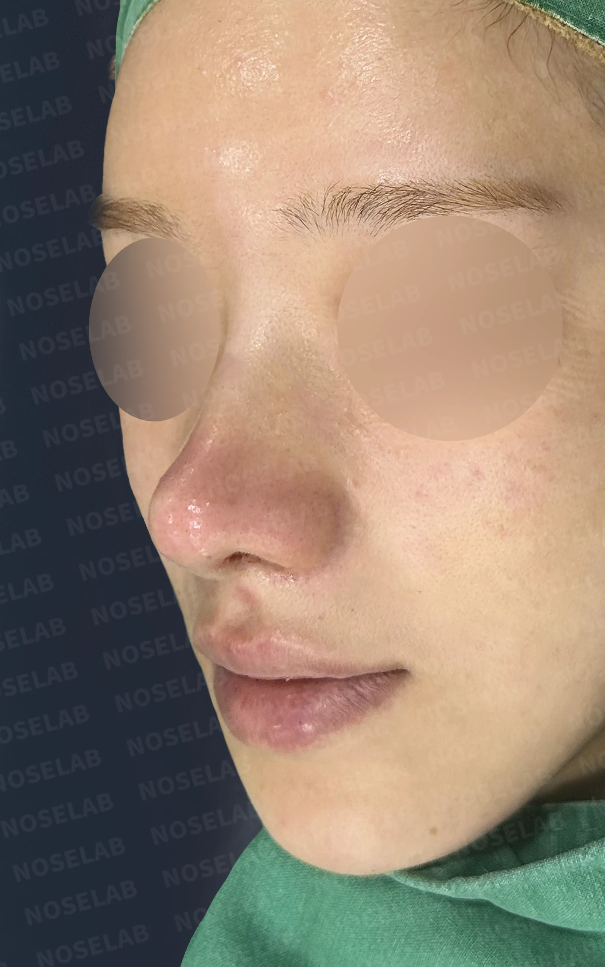 여러 차례 수술 뒤에도 코막힘과 휜 코가 남는 이유 — 수술 전 / 수술 직후 0일 직후 사진은 부기가 있는 상태로 최종 결과와 다를 수 있습니다.
