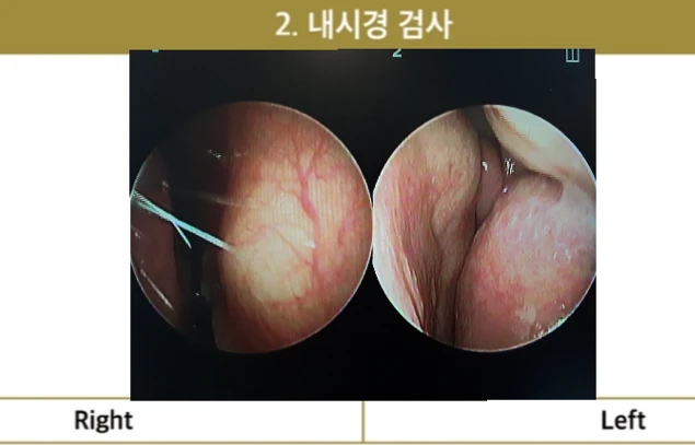 작고 뭉툭한 코의 교정 방법 — 본문 사진 1