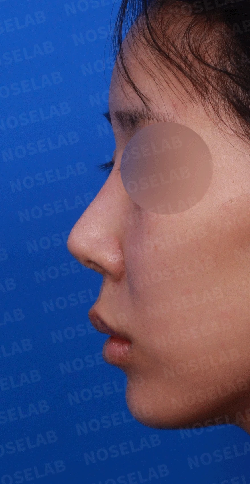 여러 번 수술한 코에 연골이 비치는 이유와 점막·구조 복원 방법 — 디자인 상담 정면 , 좌측 비스듬한 측면 , 측면 사진입니다.
