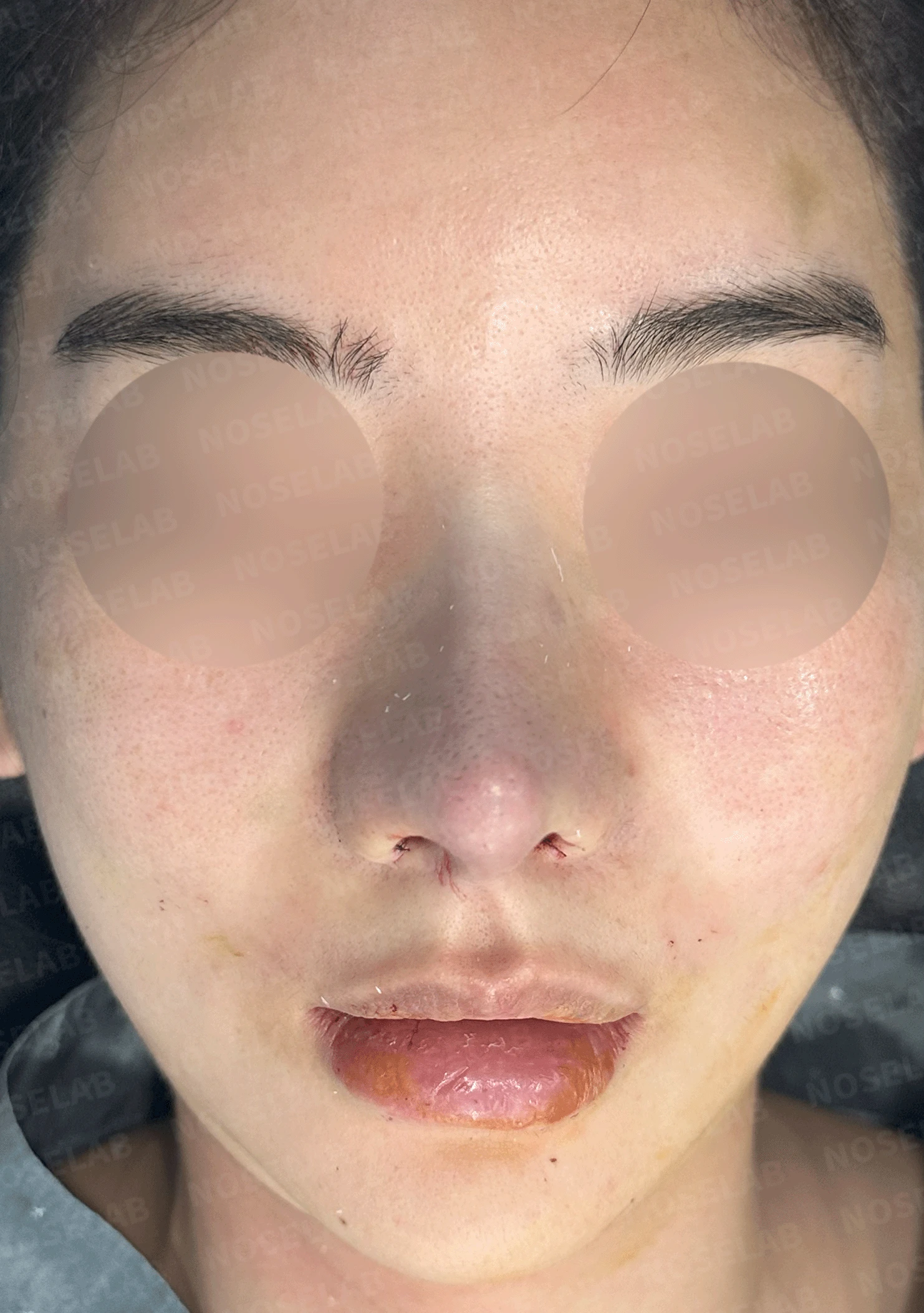 코가 과하게 높아져 부자연스러워 보이고 휘는 이유, 재건은 어떻게 하나 — 수술 전 / 수술 직후 0일 직후 사진은 부기가 있는 상태로 최종 결과와 다를 수 있습니다.