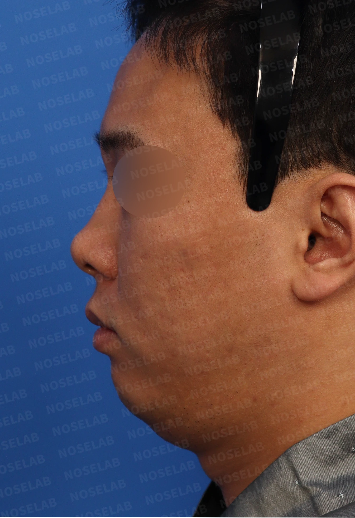 짧은 코와 들린 코의 교정 방법 — 본문 사진 3