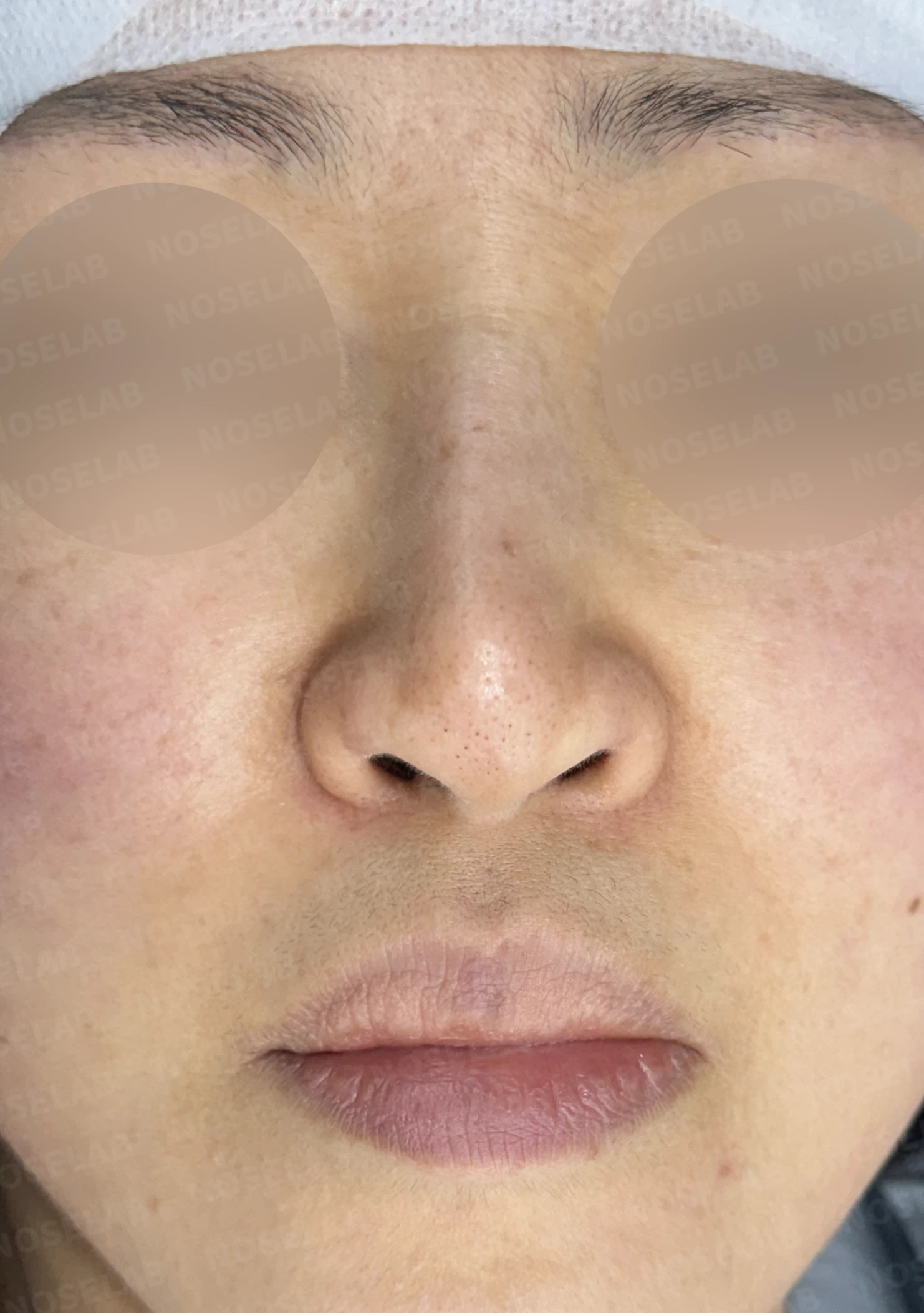 보형물 비침과 용코, 자가늑연골로 안전하게 교정한 코재수술 — 전(좌) 직후(후)