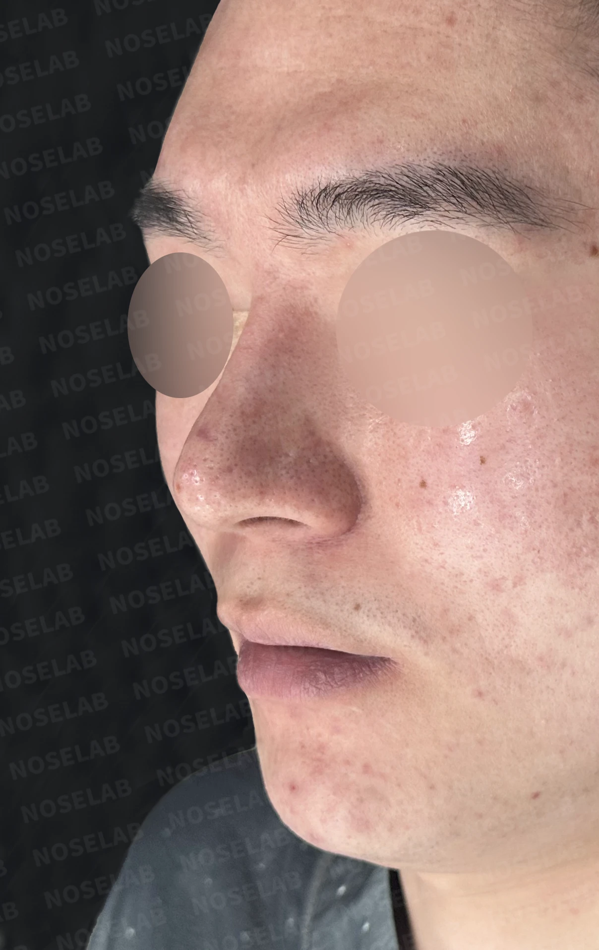 콧대를 더 높이고 싶을 때 무엇이 한계를 만드나, 3D 맞춤 보형물과 자가늑연골 코끝 지지 — 수술 전 / 수술 직후 0일 직후 사진은 부기가 있는 상태로 최종 결과와 다를 수 있습니다.