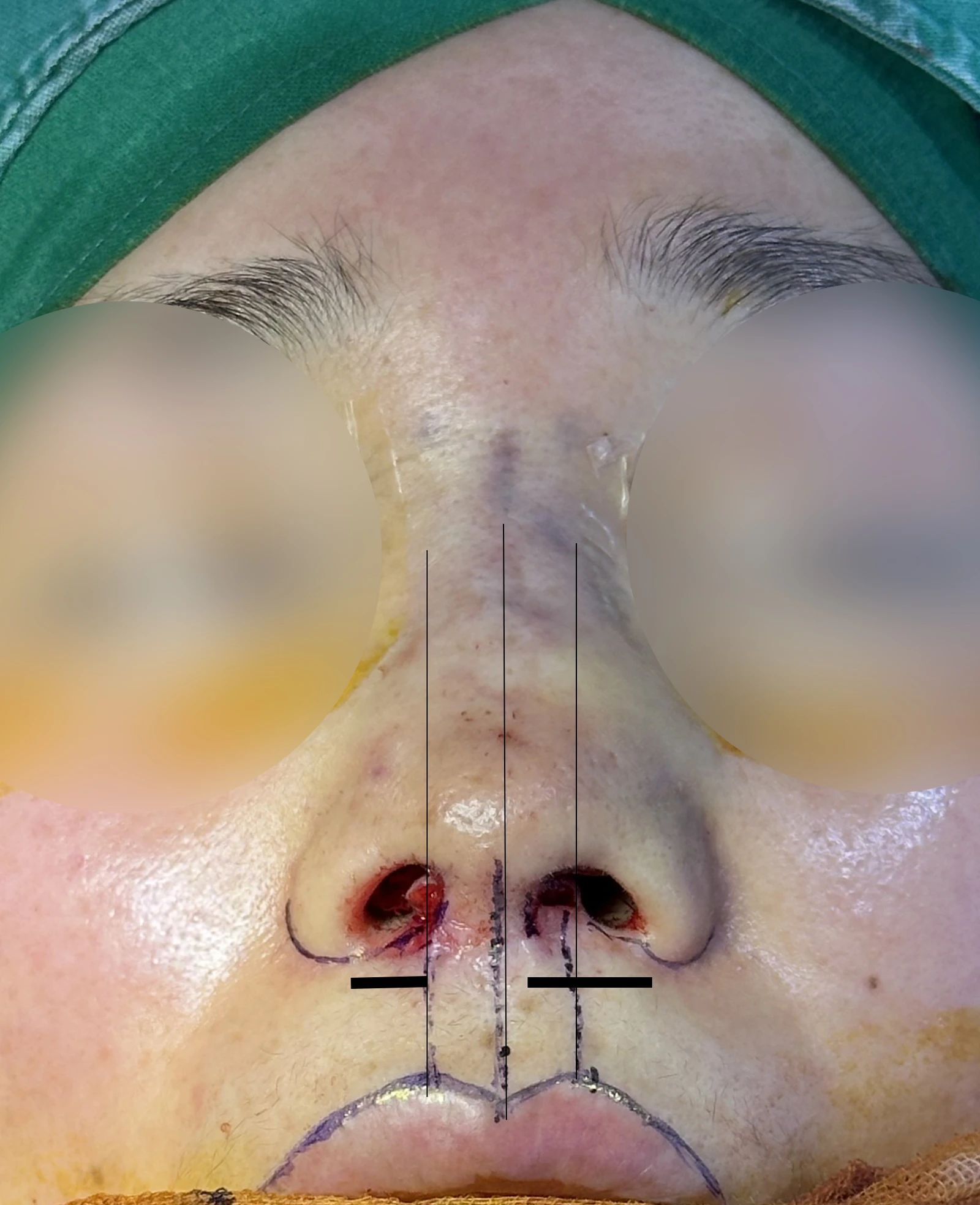 인중축소술 교정과 자가진피 제거 가능한가요? — 본문 사진 5