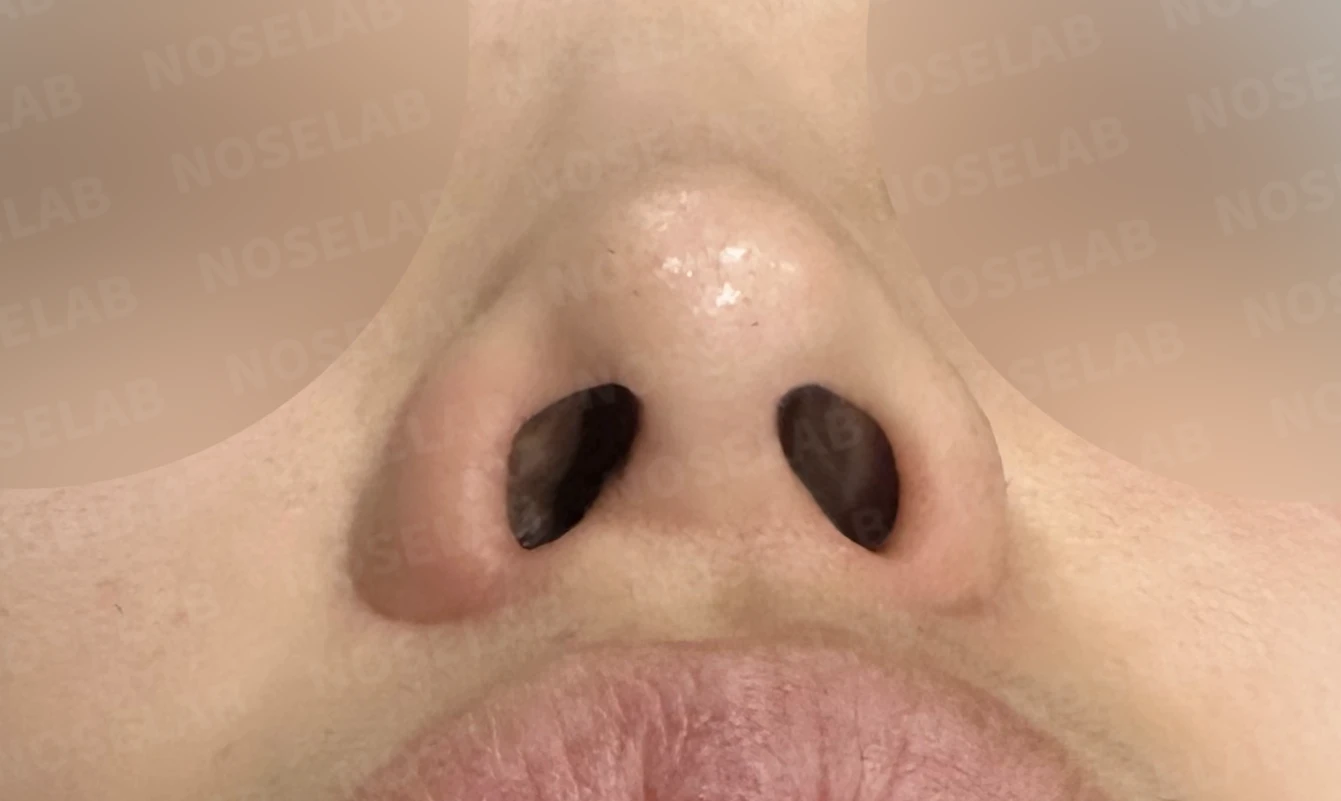 코성형 뒤 코끝이 처져 코가 길어 보이는 이유, 자가늑연골 코끝 재건 방법 — 수술 전 / 수술 직후 0일 직후 사진은 부기가 있는 상태로 최종 결과와 다를 수 있습니다.