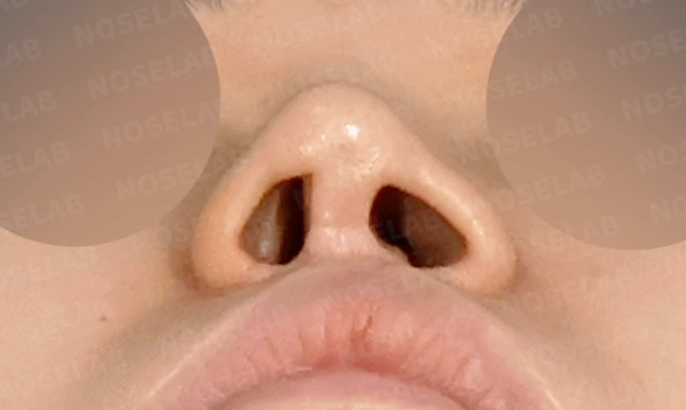 콧구멍 좌우가 심하게 달라 보이는 이유, 연골 재건과 피부이식 교정은 어떻게 하나 — 수술 전 / 수술 직후 0일 직후 사진은 부기가 있는 상태로 최종 결과와 다를 수 있습니다.