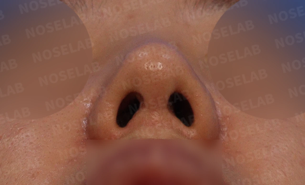 반복 수술 후 긴 코와 높은 시작점의 재수술 방법 — 본문 사진 4