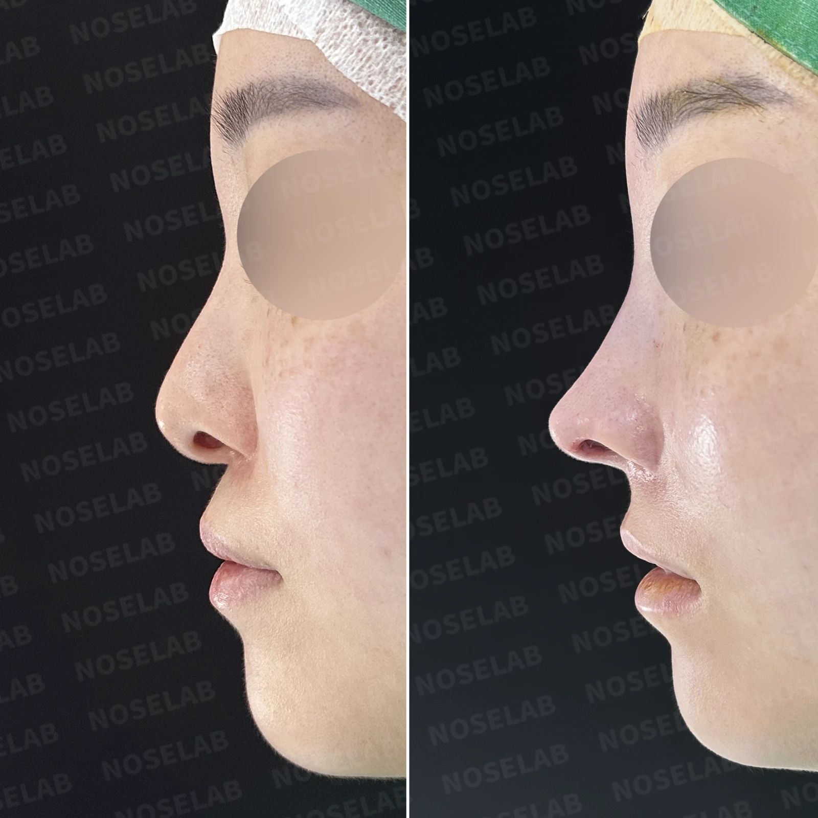 처진 비주 교정, 휜 코와 비공 비대칭까지 완벽하게 — 본문 사진 21