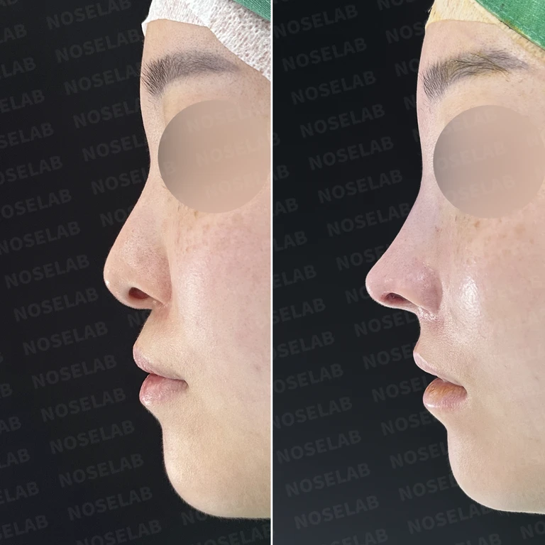 처진 비주 교정, 휜 코와 비공 비대칭까지 완벽하게 — 전후 비교