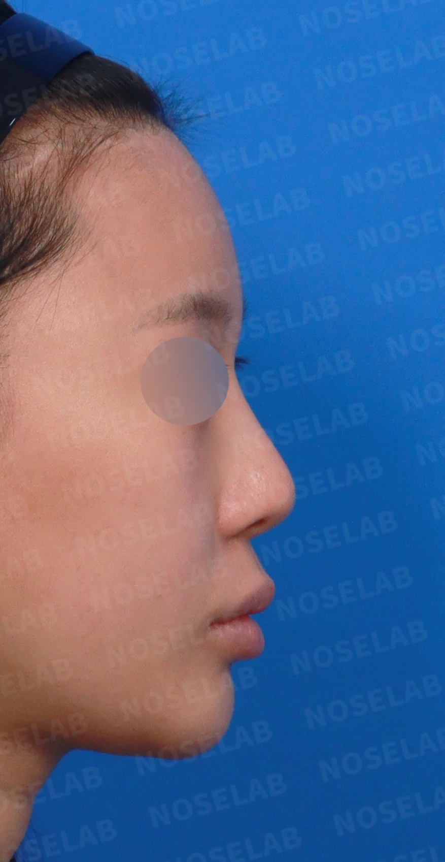 비중격 천공이 생기면 무엇이 문제이고 어떻게 재건하나 — 디자인 상담 우측 측면, 비스듬한 측면, 비공 사진입니다.
