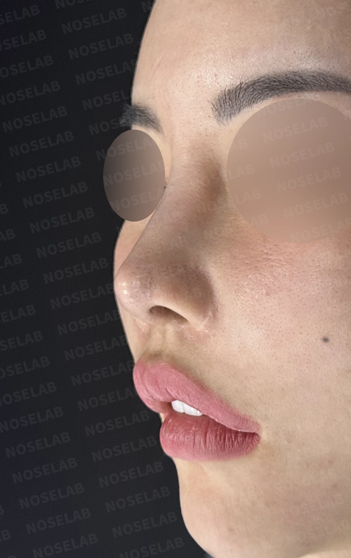 여러 차례 코 수술 뒤 내부 구조가 무너지는 이유와 늑연골 전체 재건 — 수술 전 / 수술 직후 0일 직후 사진은 부기가 있는 상태로 최종 결과와 다를 수 있습니다.