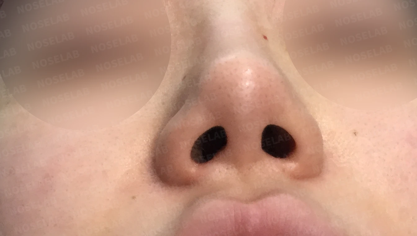 콧대 시작점과 비주를 함께 낮추는 교정 방법 — 수술 전 / 수술 직후 0일 직후 사진은 부기가 있는 상태로 최종 결과와 다를 수 있습니다.