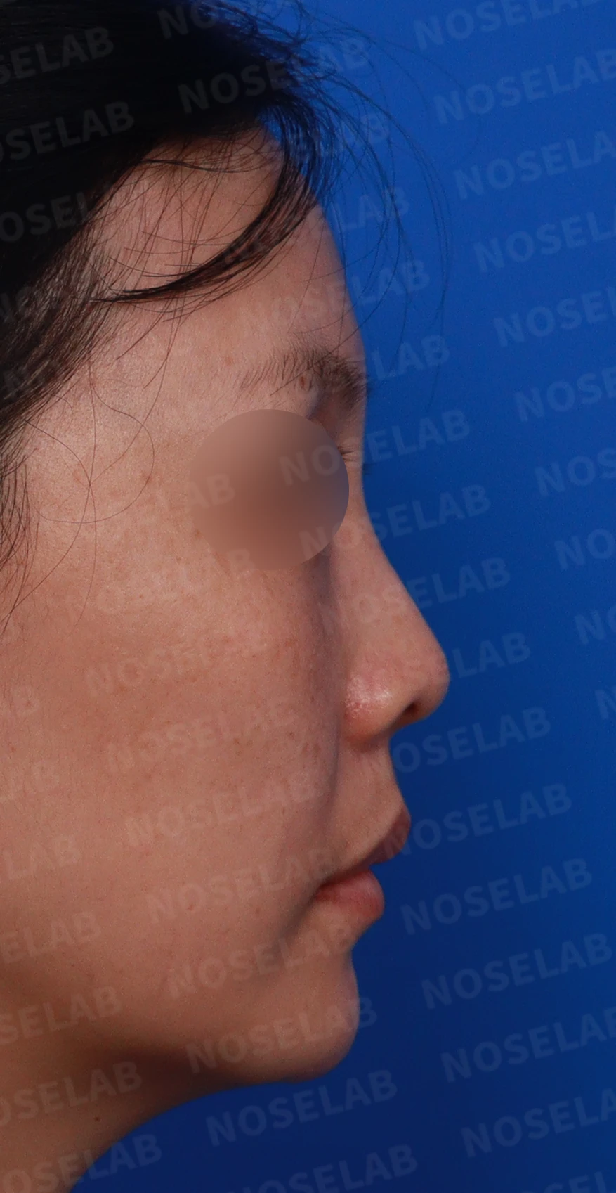 첫 코성형에서 코끝 구조와 콧구멍 노출은 어떻게 다루나 — 디자인 상담 우측 측면 , 비스듬한 측면 , 비공 사진입니다.