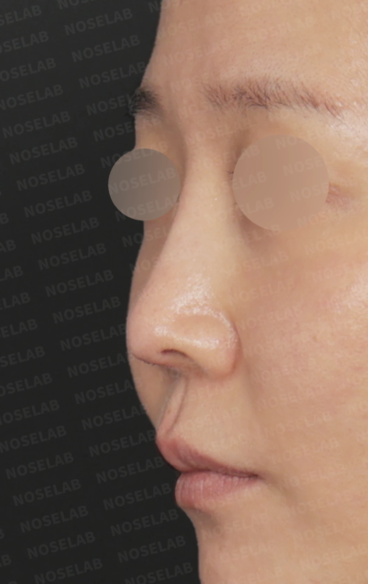 코끝 피부 함몰과 보형물 비침, 자가늑연골로 안전하게 복원한 코재수술 — 전(좌) 직후(우)