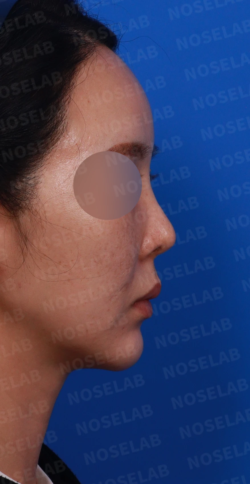 들린 코에서 콧구멍이 삼각형으로 드러나는 이유, 비공 모양 교정은 어떻게 하나 — 디자인 상담 우측 비스듬한 측면, 측면, 비공 사진
