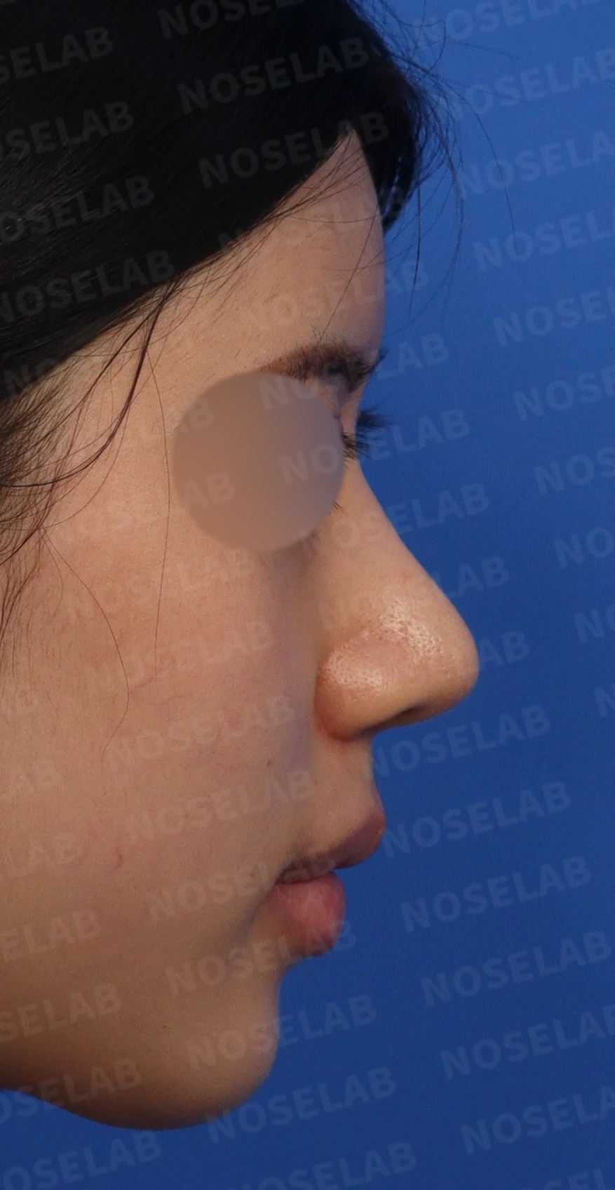 뭉툭한 코에서 화려한 코로의 변신: 맞춤형 코성형 여정 — 수술전 디자인 상담 정면, 측면, 비스듬한 측면