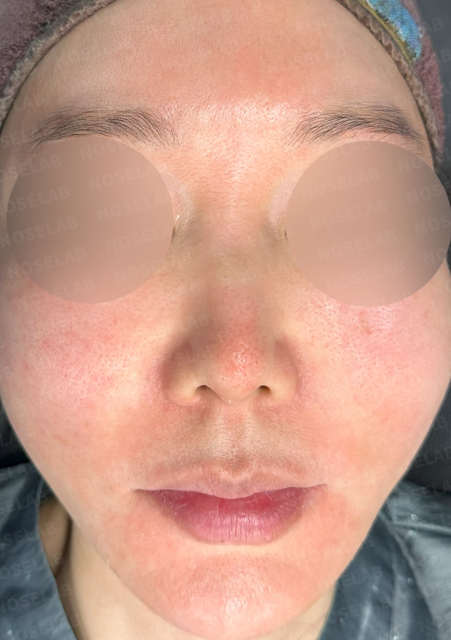 매부리를 깎은 뒤 다시 매부리가 보이고 콧구멍이 드러나는 이유 — 수술 전 / 수술 직후 0일 직후 사진은 부기가 있는 상태로 최종 결과와 다를 수 있습니다.