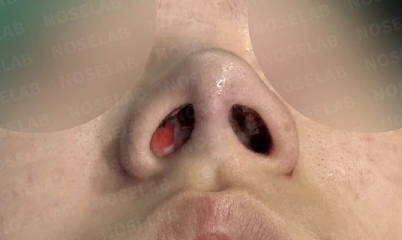 뭉툭한 코끝과 퍼진 코, 자가늑연골 비중격 연장술로 자연스럽게 교정 — 수술직후 비공 사진입니다.