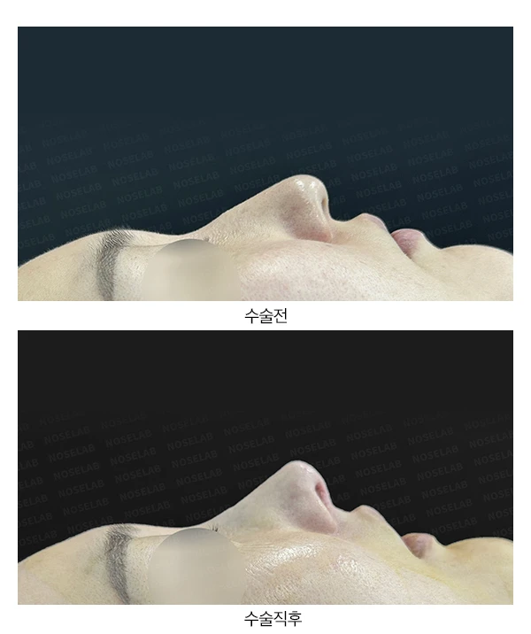 처진코 교정 수술(무보형물) 방법 — 본문 사진 13