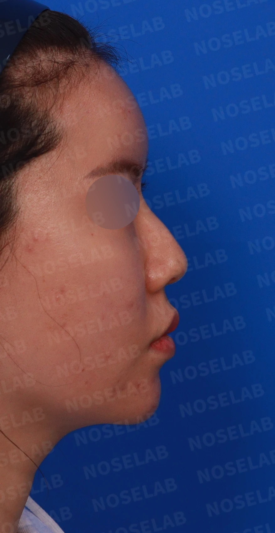 녹지 않고 남은 코 필러와 넓은 콧날개, 원인과 제거·교정 방법 — 디자인 상담 우측 측면 , 비스듬한 측면 , 비공 사진입니다.