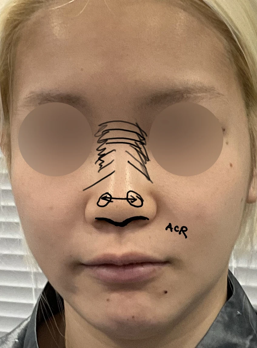 뭉툭한코와 돌출입 개선 방법 — 본문 사진 2