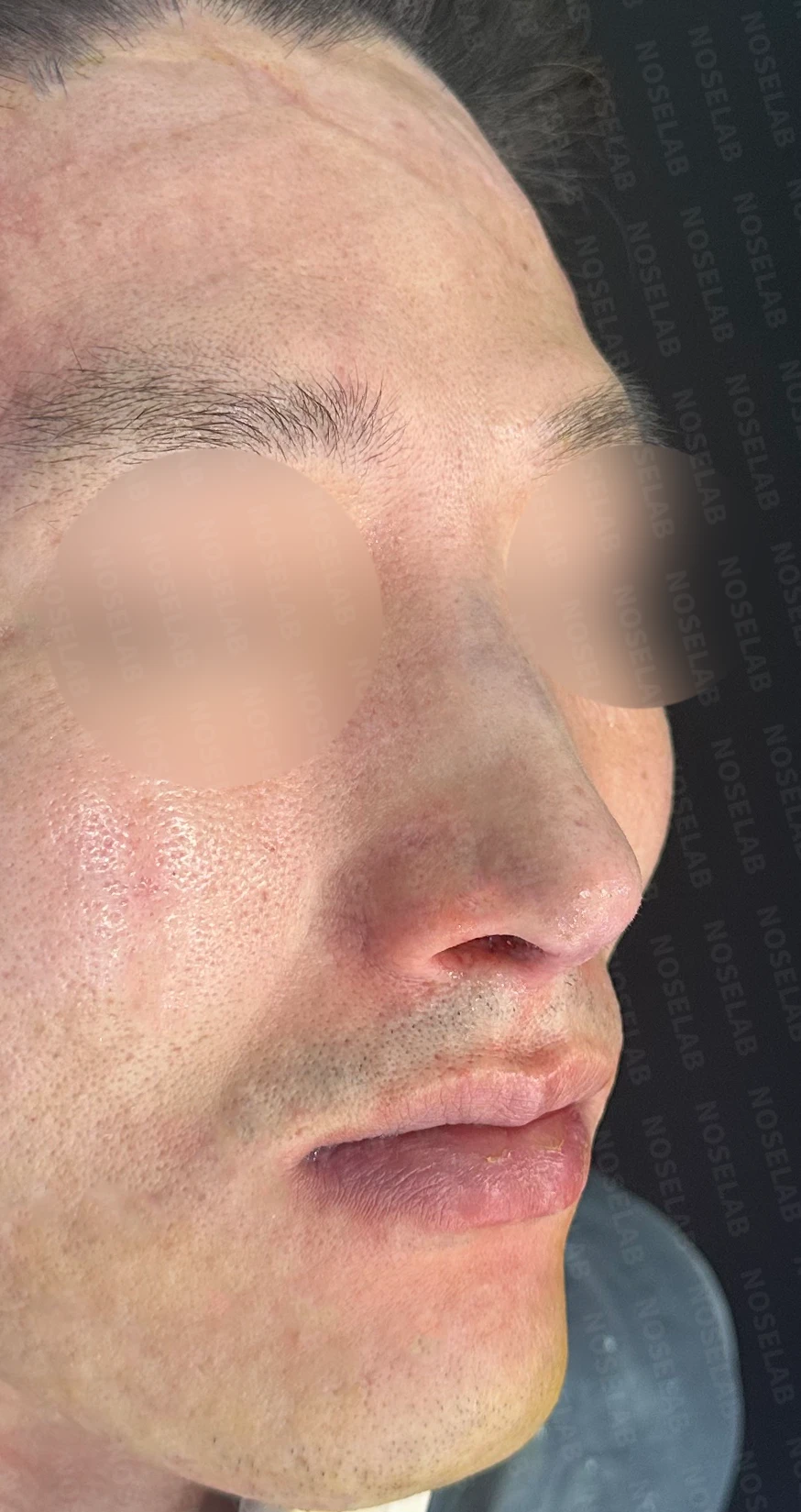 매부리코·휜코 교정 방법 — 수술 직후 0일 사진 측면, 비스듬한 측면, 정면 직후 사진은 부기가 있는 상태로 최종 결과와 다를 수 있습니다.