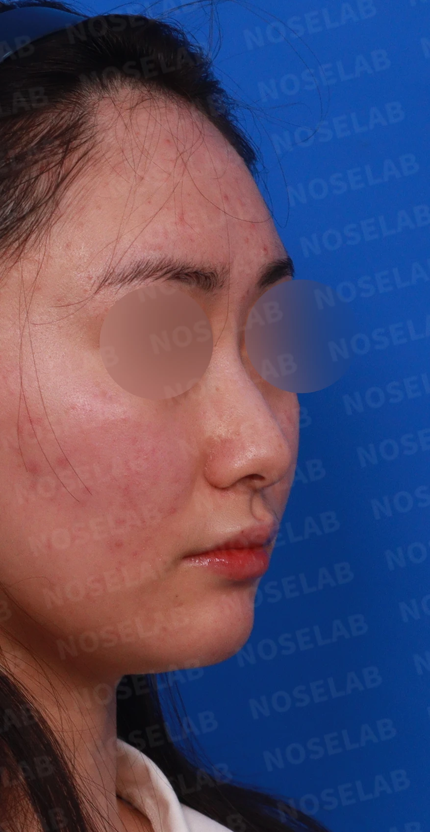 코끝이 뭉툭하게 퍼지고 코가 휘어 보이는 이유, 늑연골 재건은 어떻게 하나 — 디자인 상담 우측 측면 , 비스듬한 측면 , 비공 사진입니다.