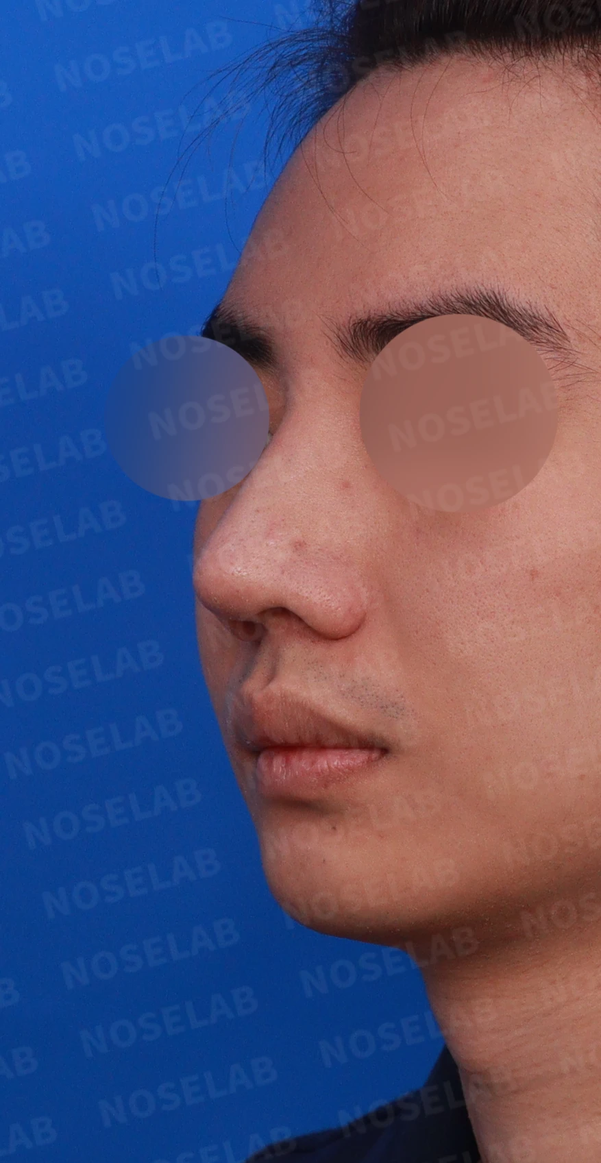 코뼈 골절에 미용 수술을 함께 할 수 있는 경우와 단계로 나누는 방법 — 디자인 상담 정면, 좌측 측면, 비스듬한 측면 사진